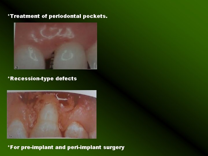 *Treatment of periodontal pockets. *Recession-type defects *For pre-implant and peri-implant surgery 
