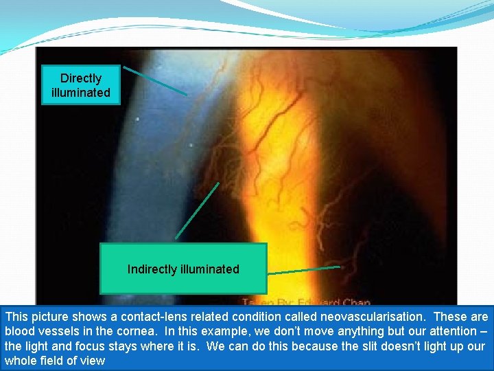 Directly illuminated Indirectly illuminated This picture shows a contact-lens related condition called neovascularisation. These