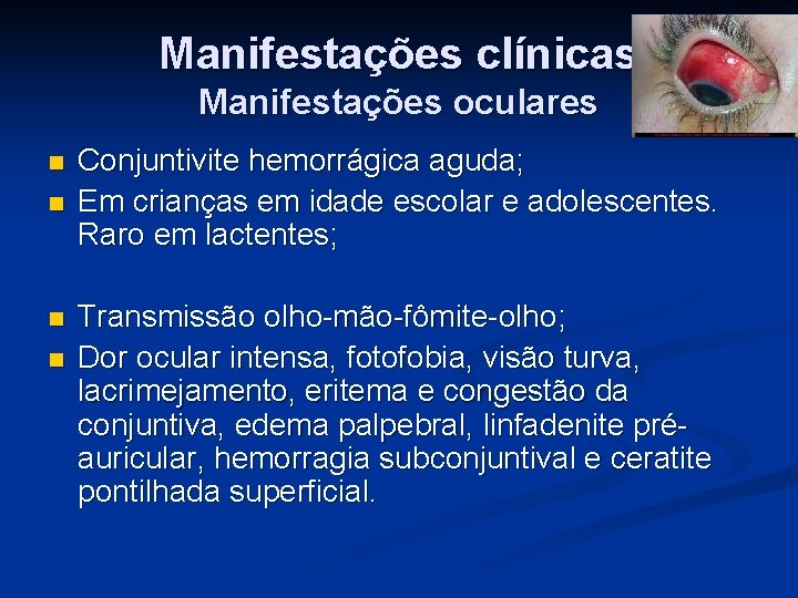 Manifestações clínicas Manifestações oculares n n Conjuntivite hemorrágica aguda; Em crianças em idade escolar