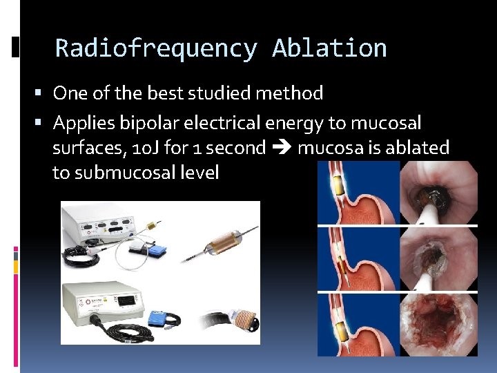 Radiofrequency Ablation One of the best studied method Applies bipolar electrical energy to mucosal