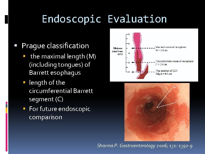 MANAGEMENT OF BARRETTS OESOPHAGUS Joint Hospital Surgical Grand