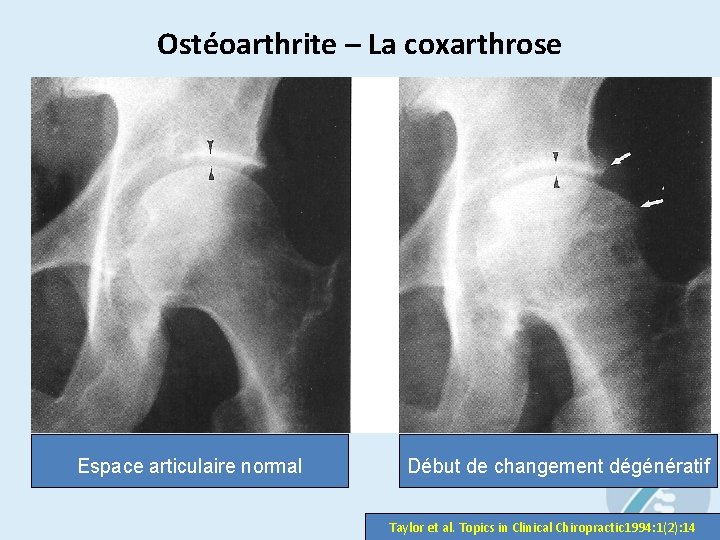 Ostéoarthrite – La coxarthrose Espace articulaire normal Début de changement dégénératif Taylor et al.