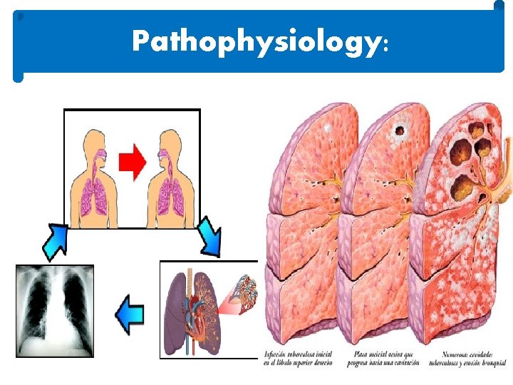 Pathophysiology: 