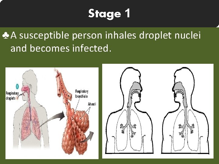 Stage 1 ♣ A susceptible person inhales droplet nuclei and becomes infected. 