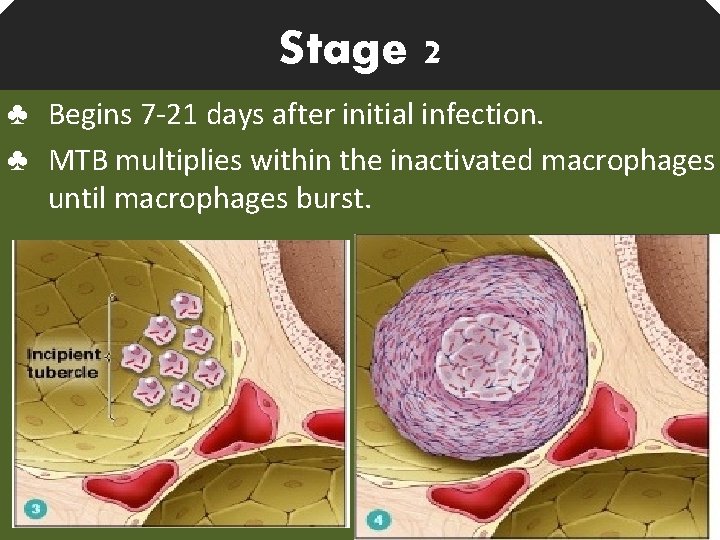 Stage 2 ♣ Begins 7 -21 days after initial infection. ♣ MTB multiplies within