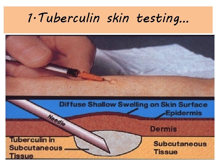 1. Tuberculin skin testing… 