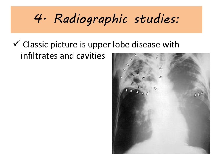 4. Radiographic studies: ü Classic picture is upper lobe disease with infiltrates and cavities