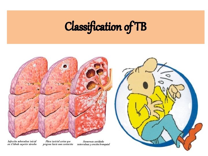 Classification of TB 