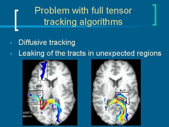 Problem with full tensor tracking algorithms • • Diffusive tracking Leaking of the tracts