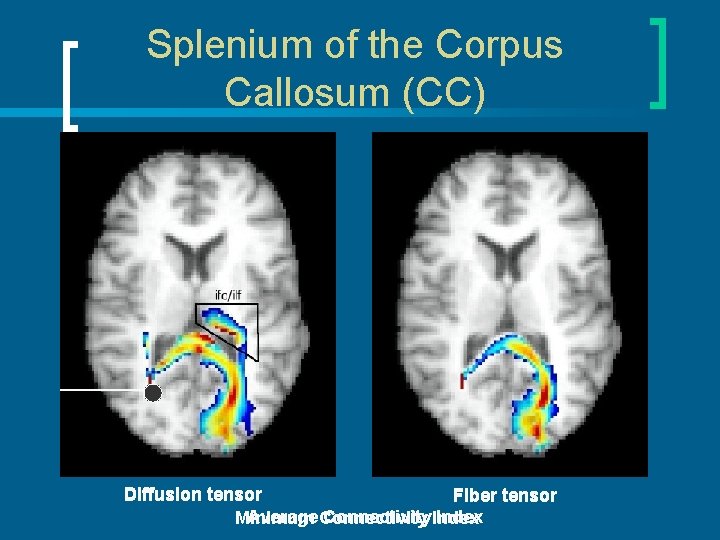 Splenium of the Corpus Callosum (CC) Diffusion tensor Fiber tensor Average Connectivity Index Minimum