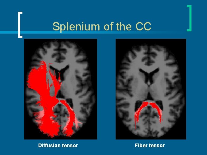 Splenium of the CC Diffusion tensor Fiber tensor 