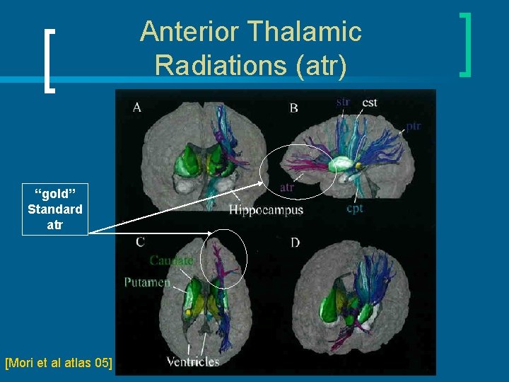 Anterior Thalamic Radiations (atr) “gold” Standard atr [Mori et al atlas 05] 