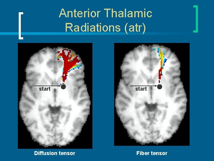 Anterior Thalamic Radiations (atr) start Diffusion tensor start Fiber tensor 