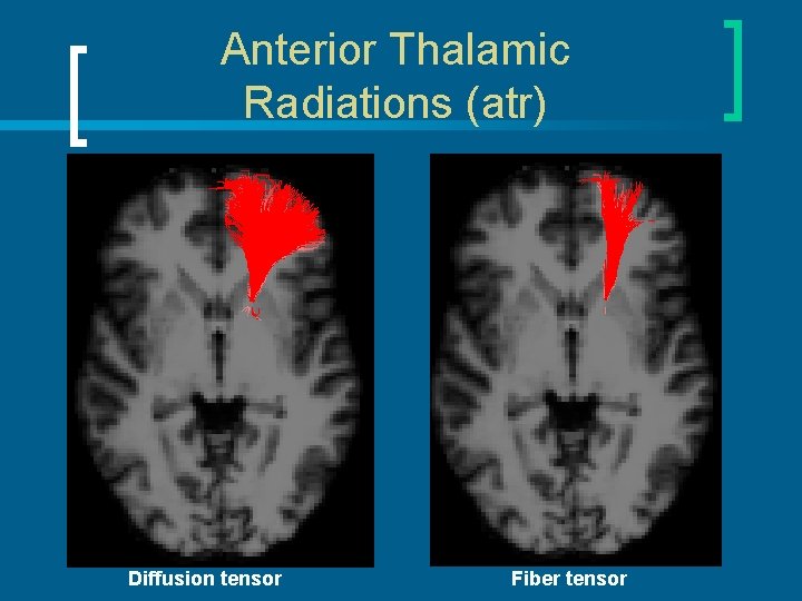 Anterior Thalamic Radiations (atr) Diffusion tensor Fiber tensor 