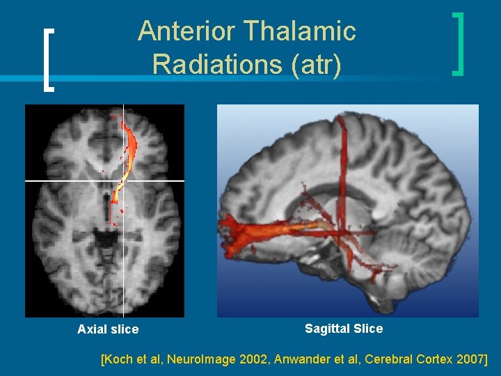 Anterior Thalamic Radiations (atr) Axial slice Sagittal Slice [Koch et al, Neuro. Image 2002,
