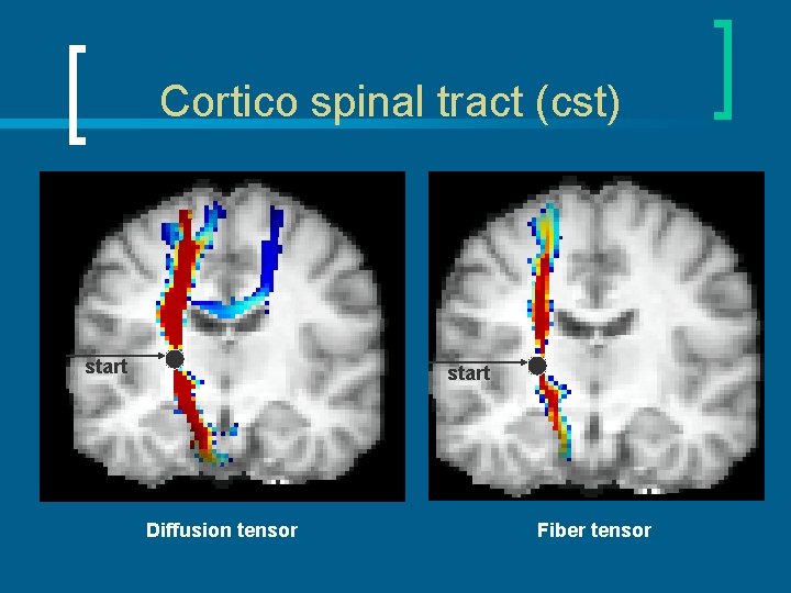 Cortico spinal tract (cst) start Diffusion tensor Fiber tensor 