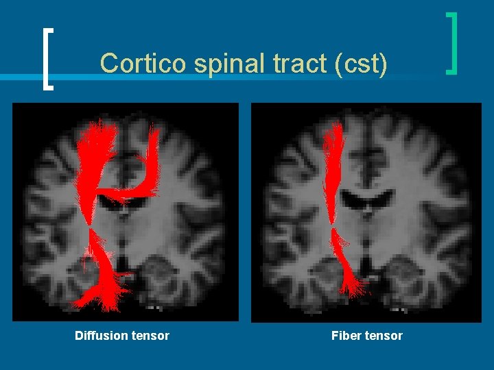 Cortico spinal tract (cst) Diffusion tensor Fiber tensor 