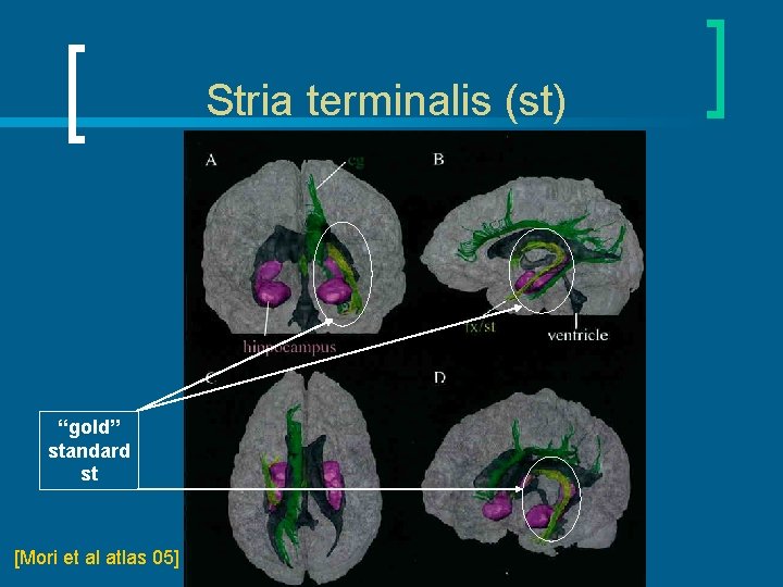 Stria terminalis (st) “gold” standard st [Mori et al atlas 05] 