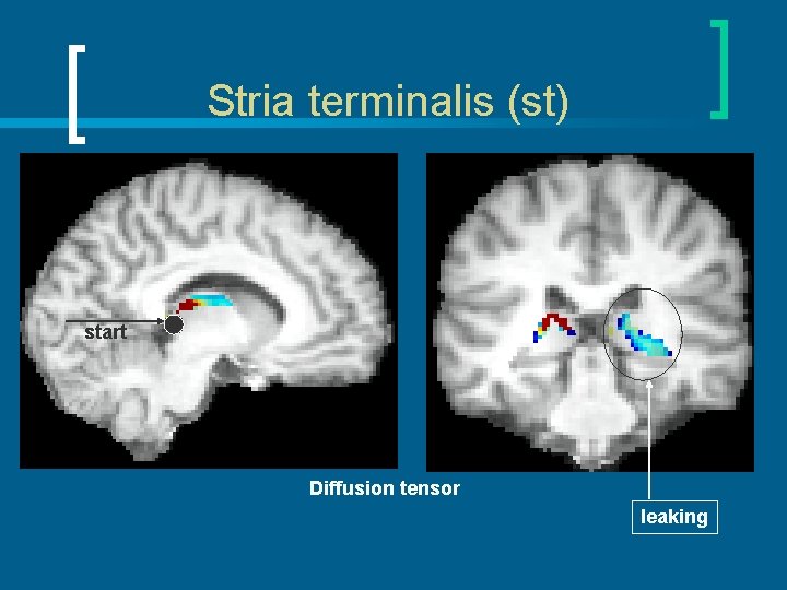 Stria terminalis (st) start Diffusion tensor leaking 