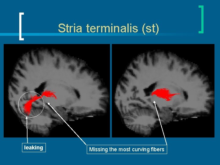 Stria terminalis (st) leaking Missing the most curving fibers 