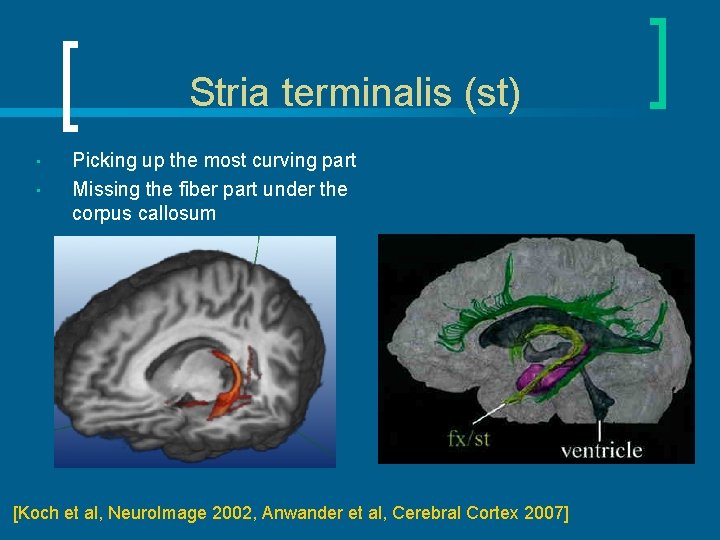Stria terminalis (st) • • Picking up the most curving part Missing the fiber