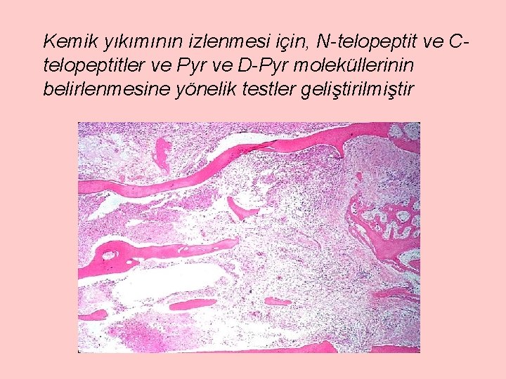 Kemik yıkımının izlenmesi için, N-telopeptit ve Ctelopeptitler ve Pyr ve D-Pyr moleküllerinin belirlenmesine yönelik