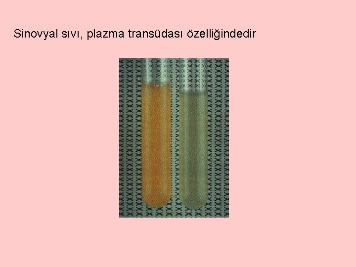 Sinovyal sıvı, plazma transüdası özelliğindedir 