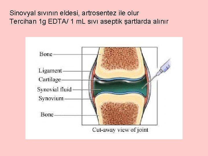 Sinovyal sıvının eldesi, artrosentez ile olur Tercihan 1 g EDTA/ 1 m. L sıvı