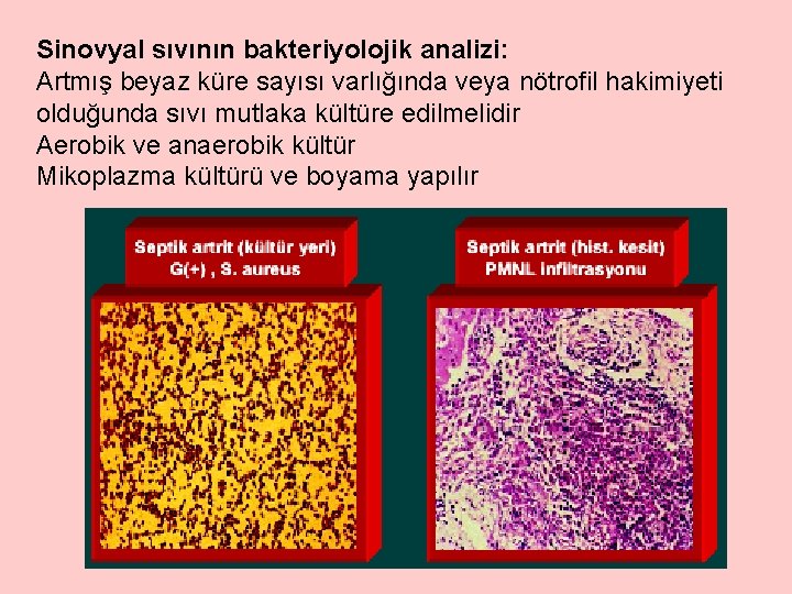 Sinovyal sıvının bakteriyolojik analizi: Artmış beyaz küre sayısı varlığında veya nötrofil hakimiyeti olduğunda sıvı