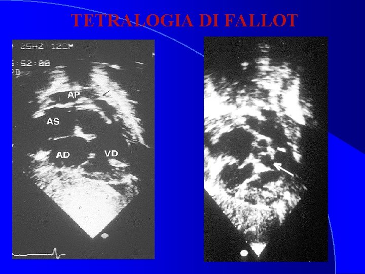 TETRALOGIA DI FALLOT 