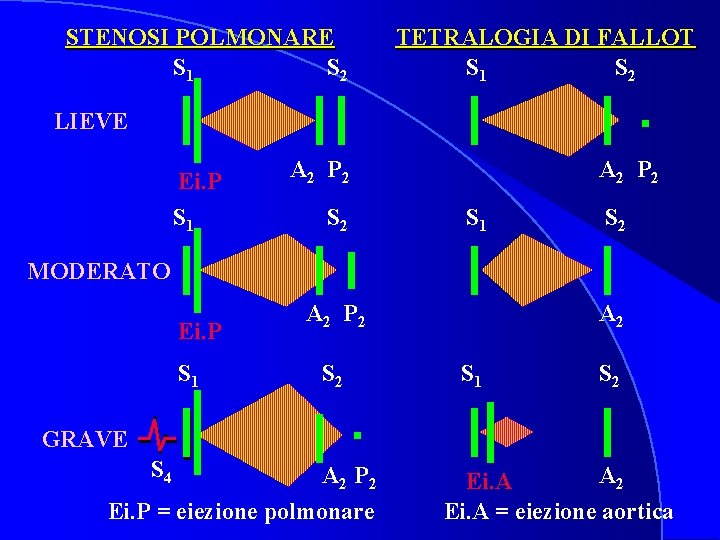 STENOSI POLMONARE S 1 S 2 TETRALOGIA DI FALLOT S 1 S 2 LIEVE