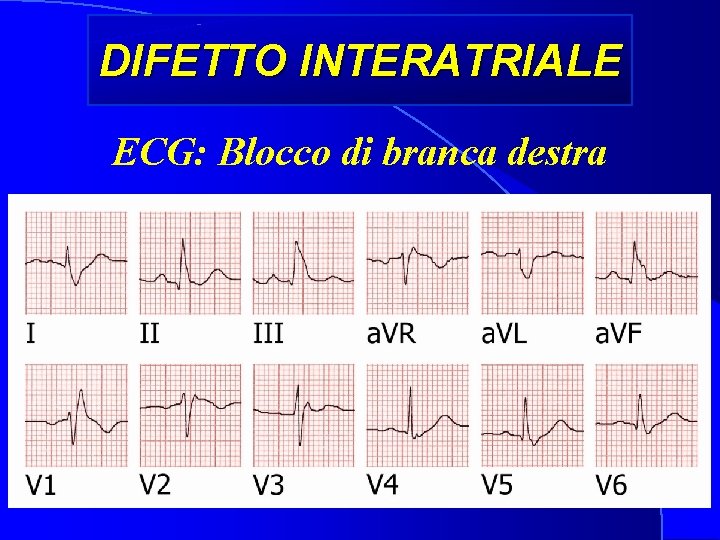 DIFETTO INTERATRIALE ECG: Blocco di branca destra 