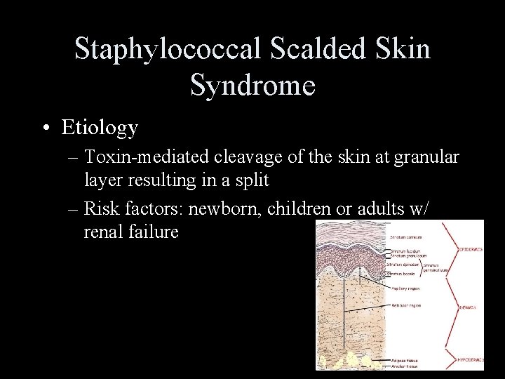 Staphylococcal Scalded Skin Syndrome • Etiology – Toxin-mediated cleavage of the skin at granular