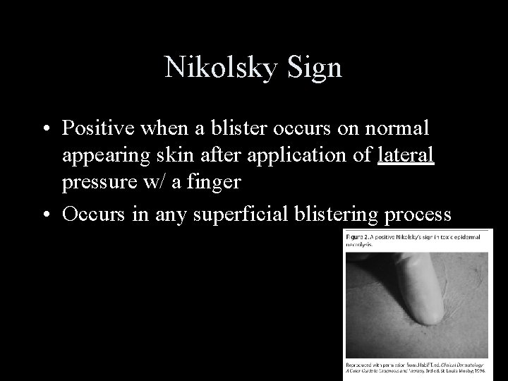 Nikolsky Sign • Positive when a blister occurs on normal appearing skin after application