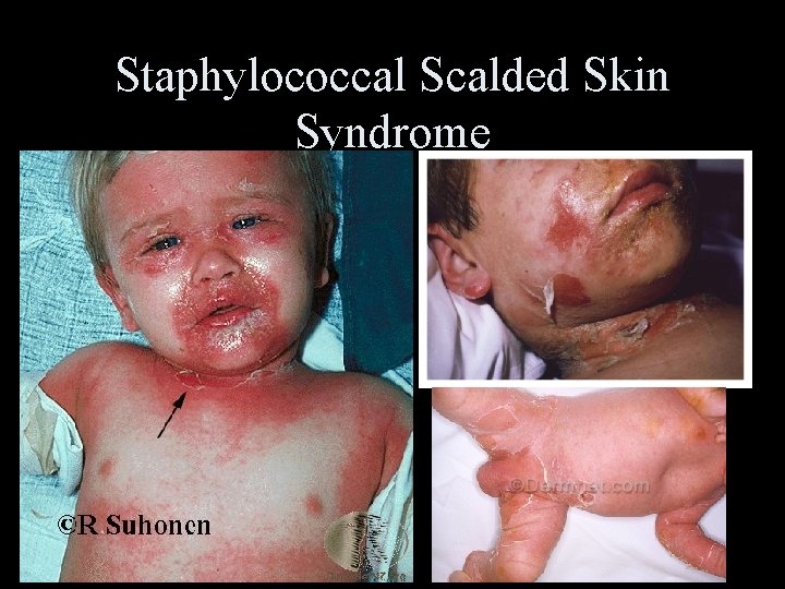 Staphylococcal Scalded Skin Syndrome 
