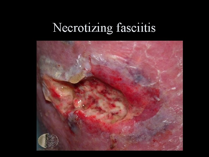 Necrotizing fasciitis 