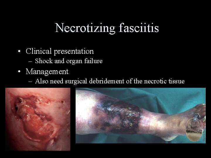 Necrotizing fasciitis • Clinical presentation – Shock and organ failure • Management – Also