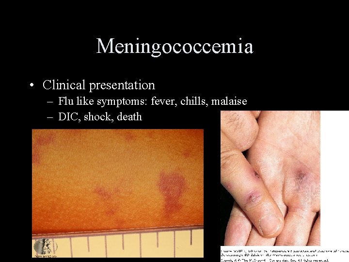 Meningococcemia • Clinical presentation – Flu like symptoms: fever, chills, malaise – DIC, shock,