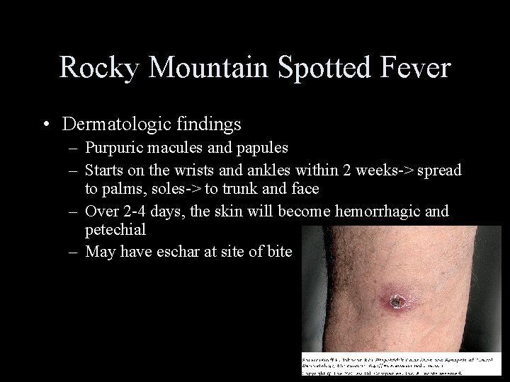 Rocky Mountain Spotted Fever • Dermatologic findings – Purpuric macules and papules – Starts
