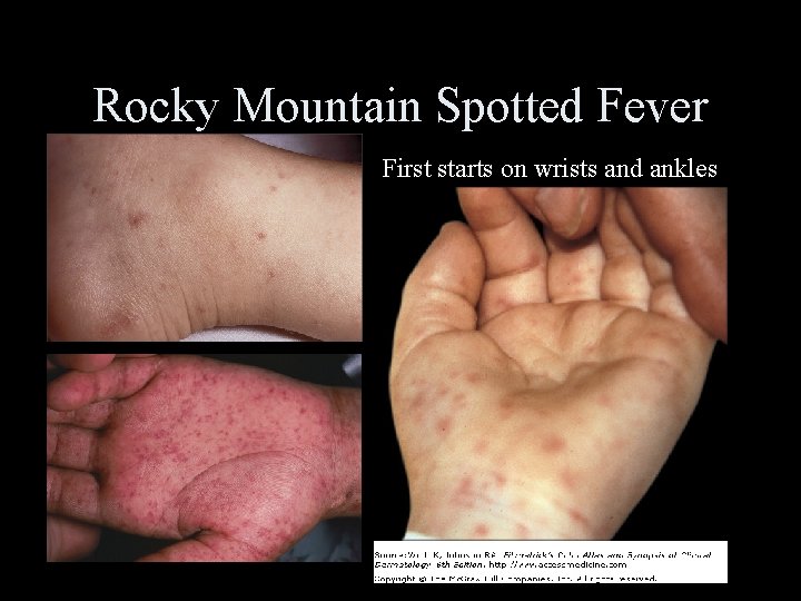 Rocky Mountain Spotted Fever First starts on wrists and ankles 