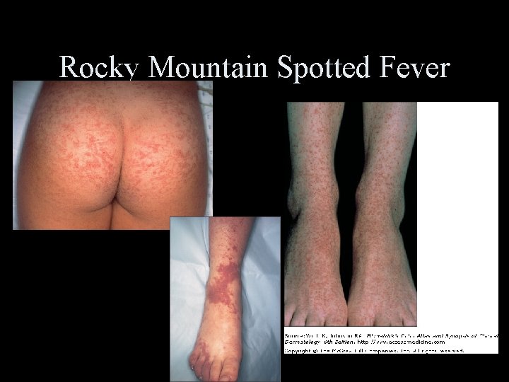 Rocky Mountain Spotted Fever 