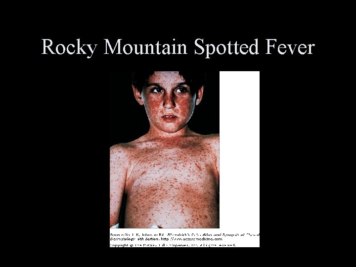 Rocky Mountain Spotted Fever 