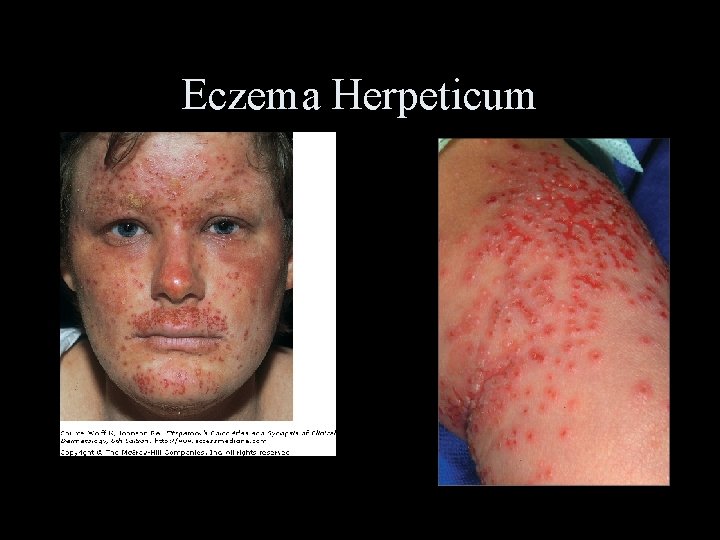 Eczema Herpeticum 
