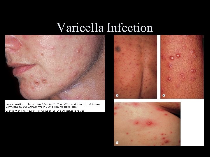 Varicella Infection 
