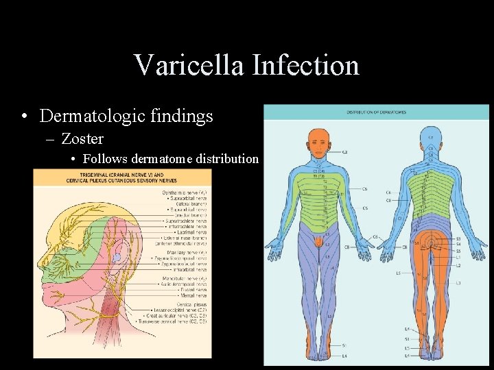Varicella Infection • Dermatologic findings – Zoster • Follows dermatome distribution 