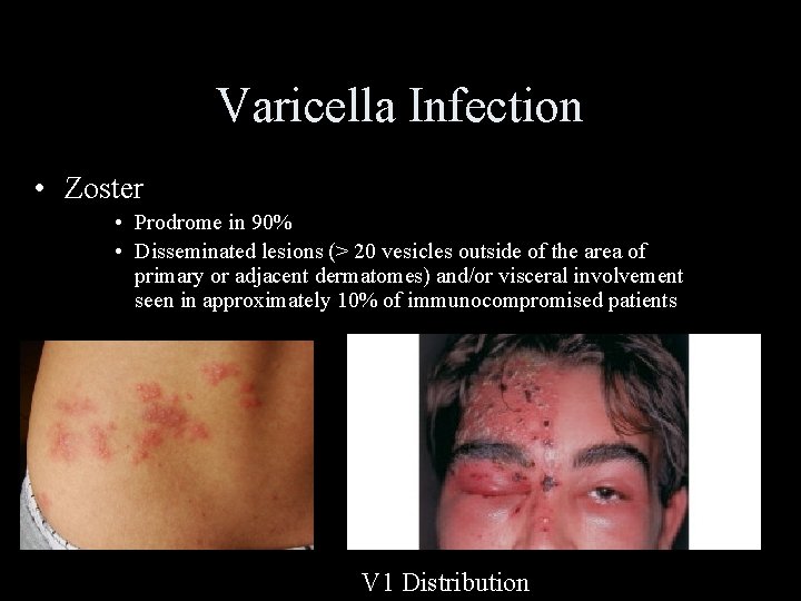 Varicella Infection • Zoster • Prodrome in 90% • Disseminated lesions (> 20 vesicles