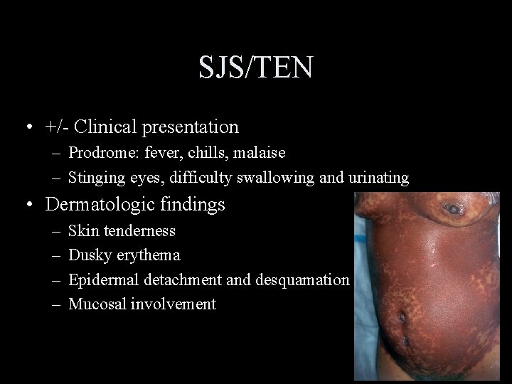 SJS/TEN • +/- Clinical presentation – Prodrome: fever, chills, malaise – Stinging eyes, difficulty