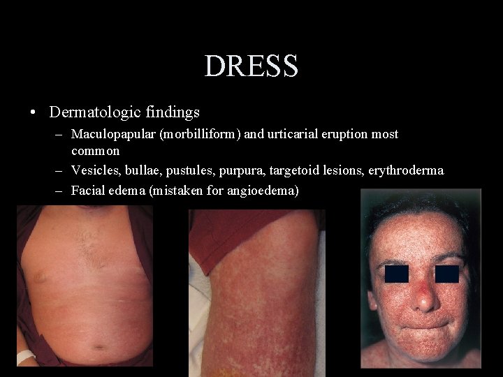 DRESS • Dermatologic findings – Maculopapular (morbilliform) and urticarial eruption most common – Vesicles,