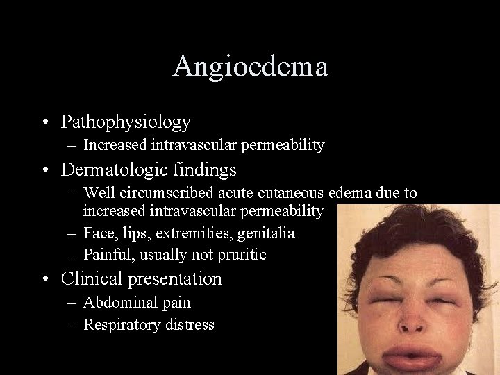 Angioedema • Pathophysiology – Increased intravascular permeability • Dermatologic findings – Well circumscribed acute