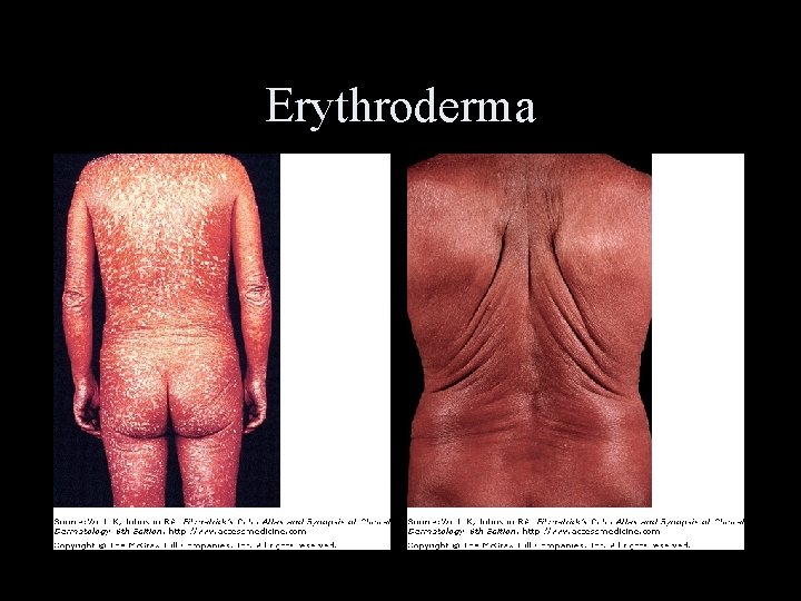 Erythroderma 
